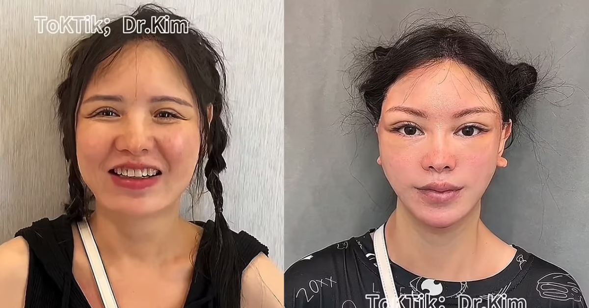 Resultados de antes e depois do médico Dr Kim - Foto: TikTok