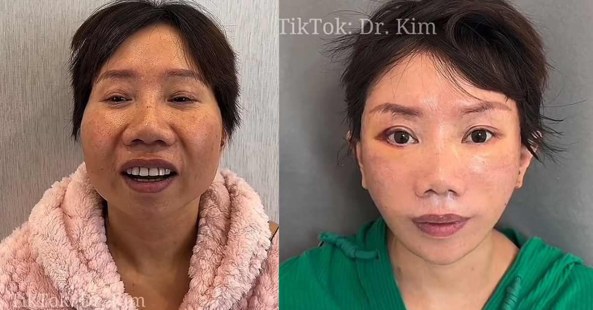Resultados de antes e depois do médico Dr Kim - Foto: TikTok